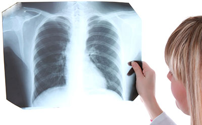 lung-xray